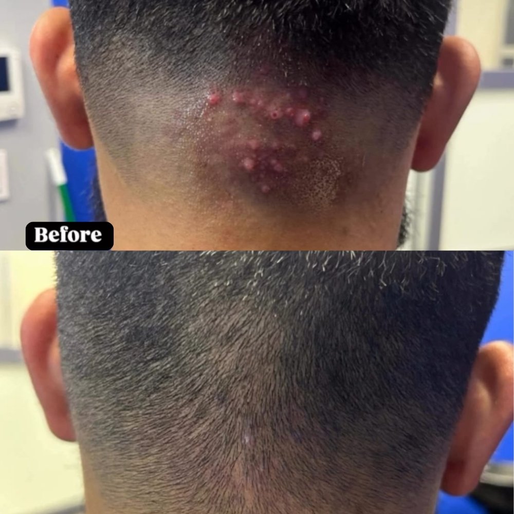 Bump Relief Kit - Image 4