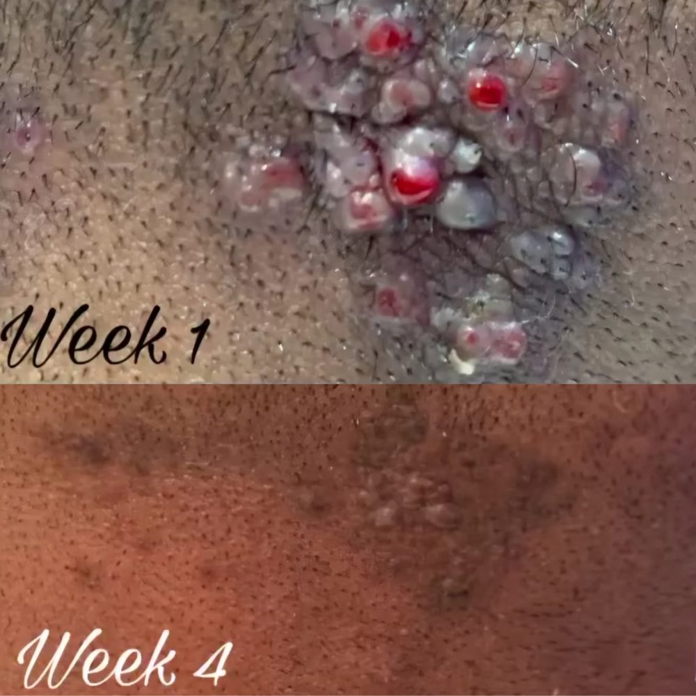 Bump Relief Kit - Image 3